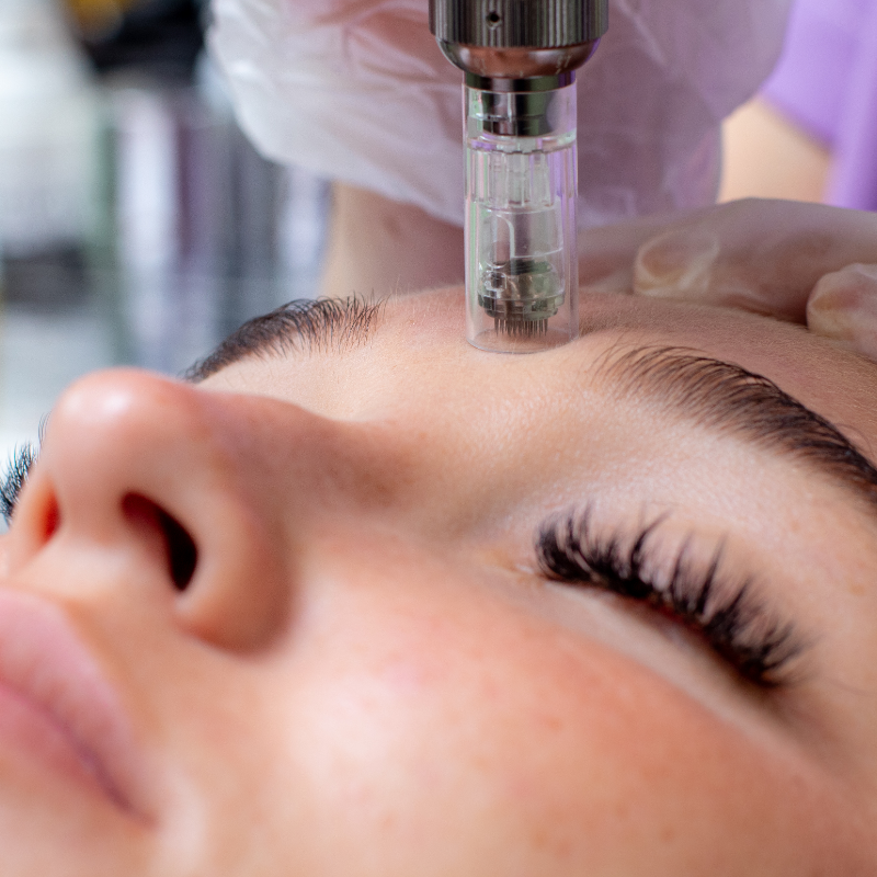 Microneedling Kosmetik Kurs – professionelle Ausbildung für effektive Hautverjüngung und regenerative Behandlungstechniken.